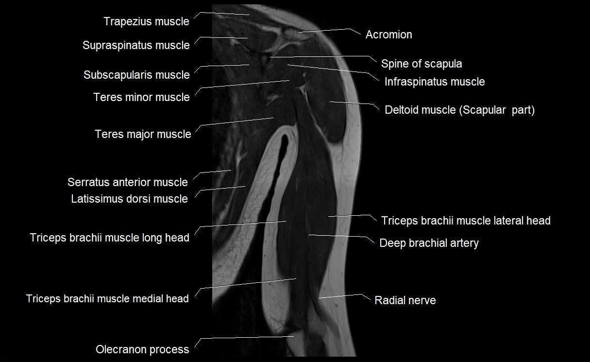 MRI upper arm (humerus ) coronal cross sectional anatomy image 21.webp